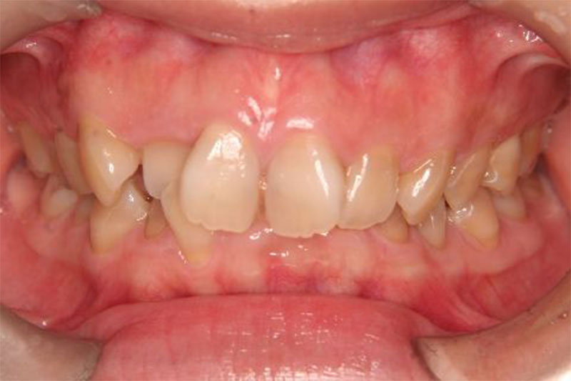 かみ込みが深い