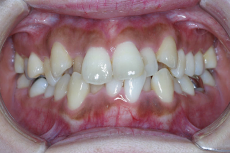 重なった歯並び