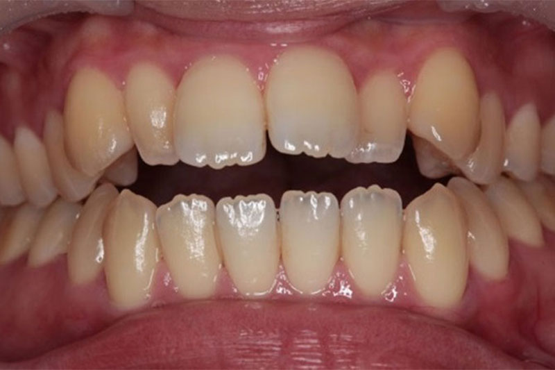 前歯でかみ切れない